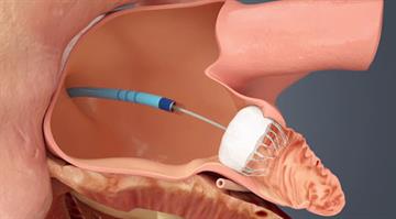 WATCHMAN_device_implanted-sm Watchman Device Implant